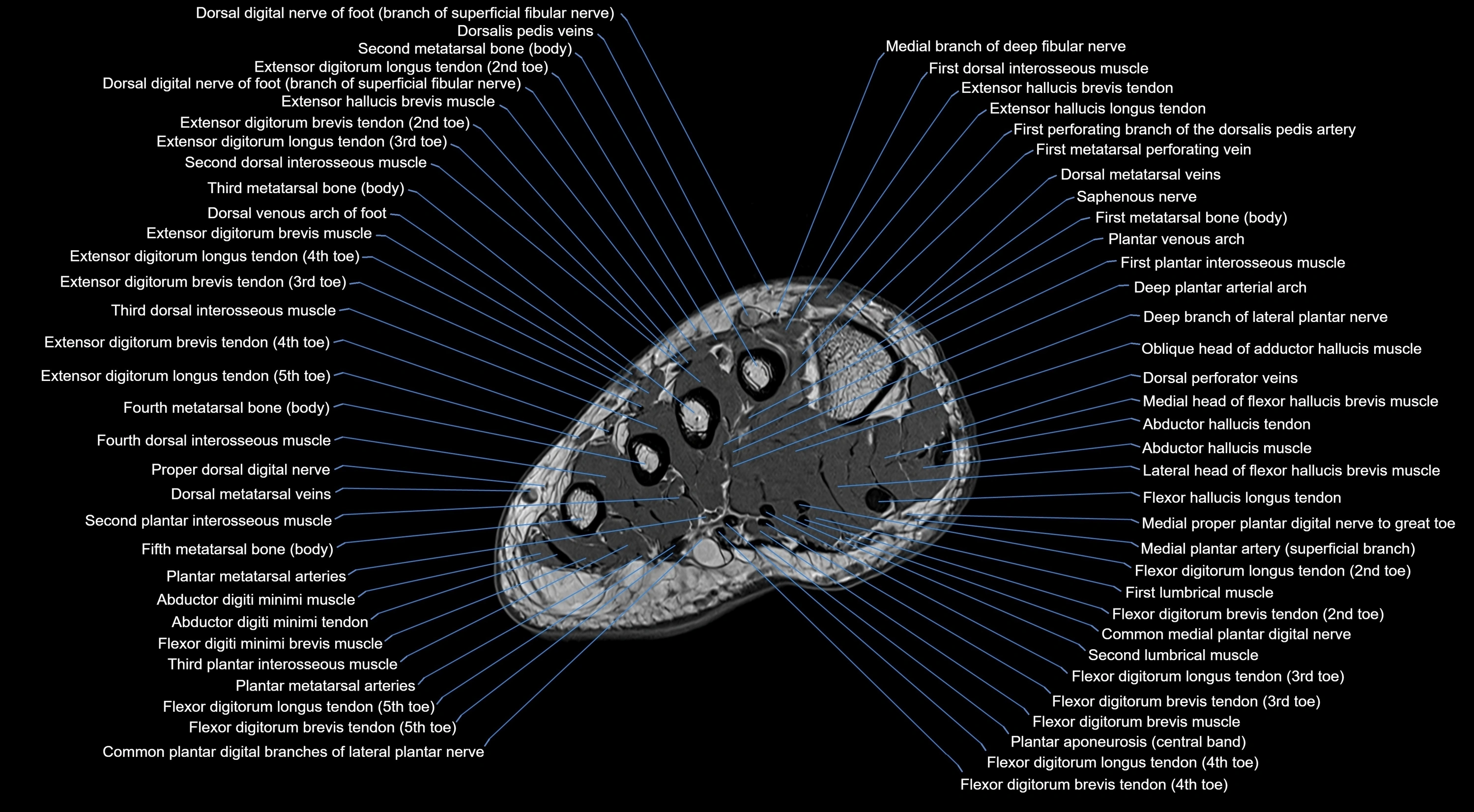 MRI mid foot coronal ligaments cross sectional anatomy 3T  radiology  image-img-00001-00005.webp